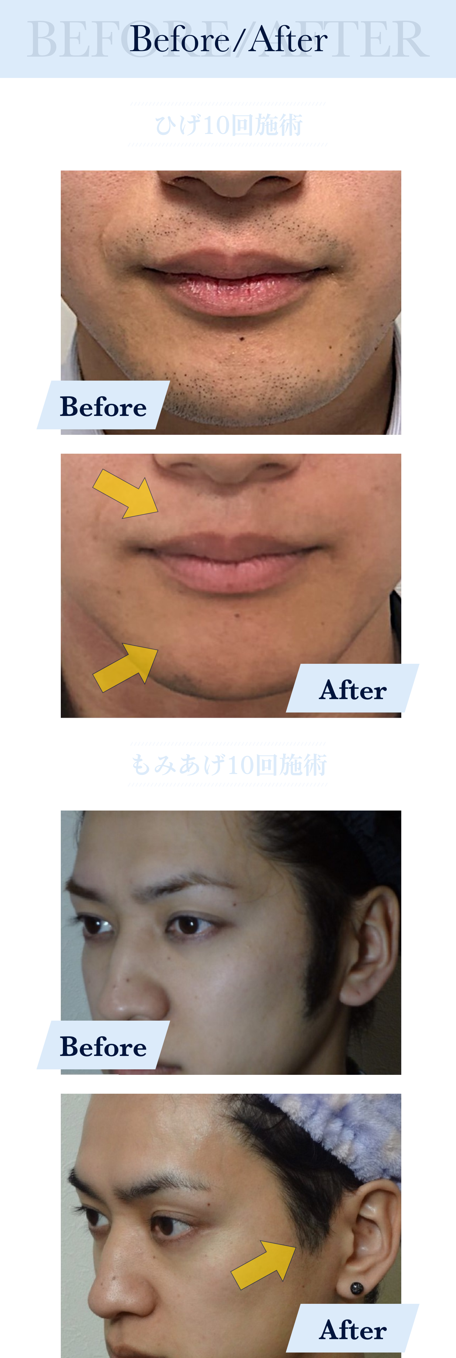 Before/After ひげ10回施術 Before After もみあげ10回施術 Before After